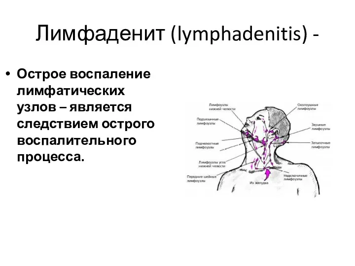 Лимфаденит (lymphadenitis) - Острое воспаление лимфатических узлов – является следствием острого воспалительного процесса.