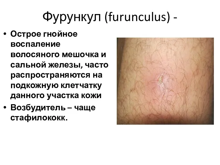 Фурункул (furunculus) - Острое гнойное воспаление волосяного мешочка и сальной железы, часто распространяются