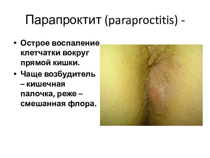 Парапроктит (paraproctitis) - Острое воспаление клетчатки вокруг прямой кишки. Чаще