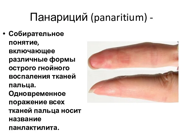 Панариций (panaritium) - Собирательное понятие, включающее различные формы острого гнойного