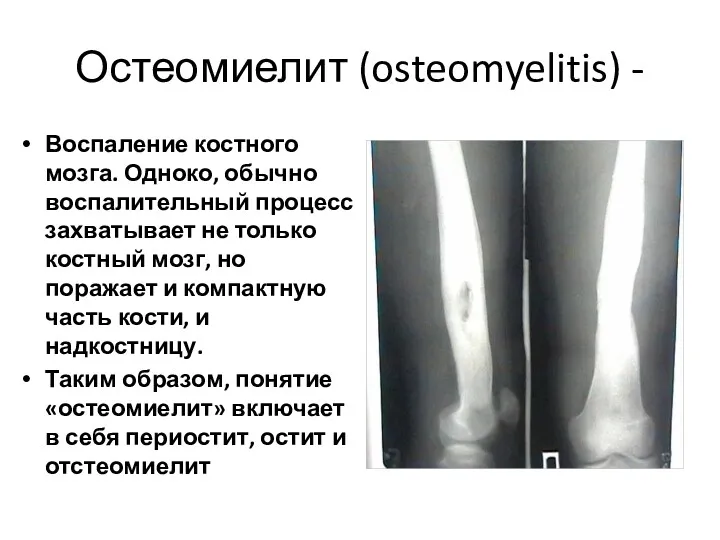 Остеомиелит (osteomyelitis) - Воспаление костного мозга. Одноко, обычно воспалительный процесс