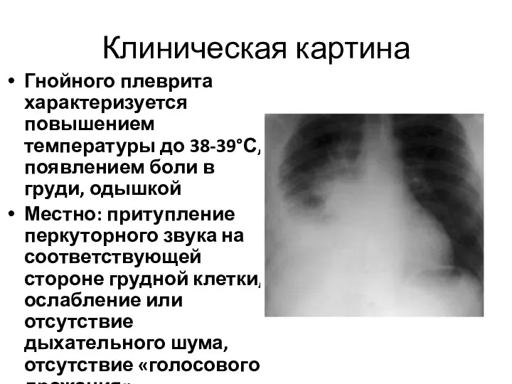 Клиническая картина Гнойного плеврита характеризуется повышением температуры до 38-39°С, появлением боли в груди,