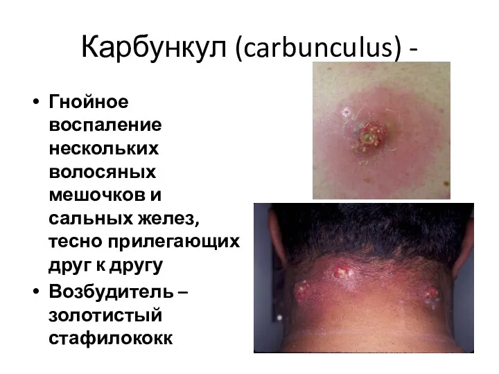 Карбункул (carbunculus) - Гнойное воспаление нескольких волосяных мешочков и сальных желез, тесно прилегающих
