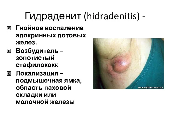 Гидраденит (hidradenitis) - Гнойное воспаление апокринных потовых желез. Возбудитель – золотистый стафилококк Локализация