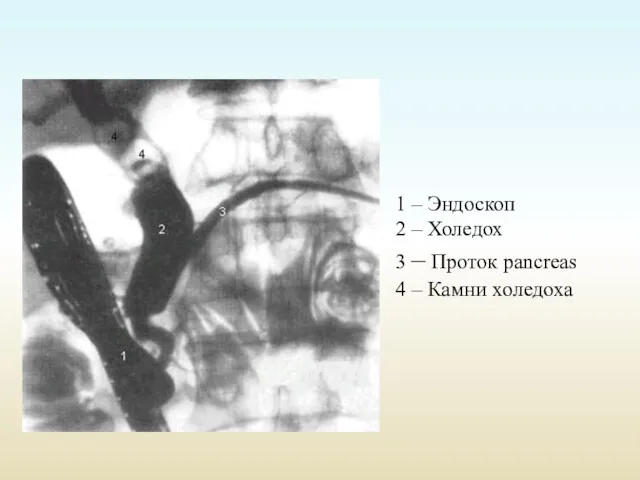 1 – Эндоскоп 2 – Холедох 3 – Проток pancreas 4 – Камни холедоха