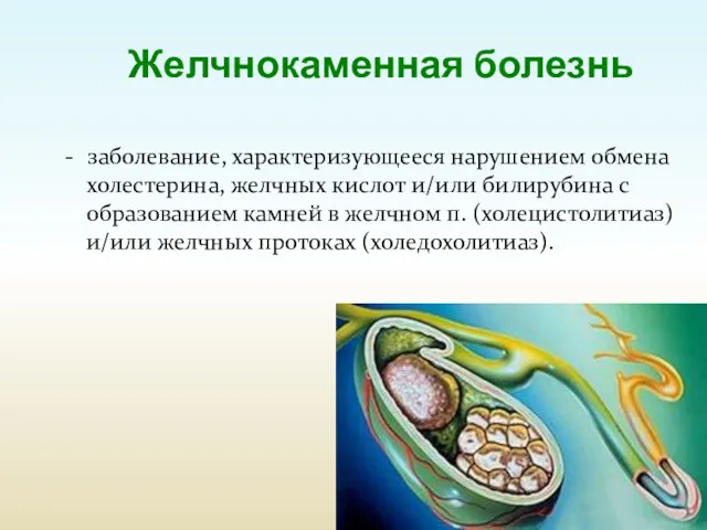 Желчнокаменная болезнь - заболевание, характеризующееся нарушением обмена холестерина, желчных кислот