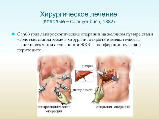 Хирургическое лечение (впервые – C.Langenbuch, 1882) C 1988 года лапароскопические