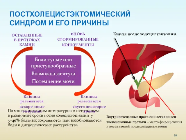 ПОСТХОЛЕЦИСТЭКТОМИЧЕСКИЙ СИНДРОМ И ЕГО ПРИЧИНЫ По многочисленным литературным источникам в