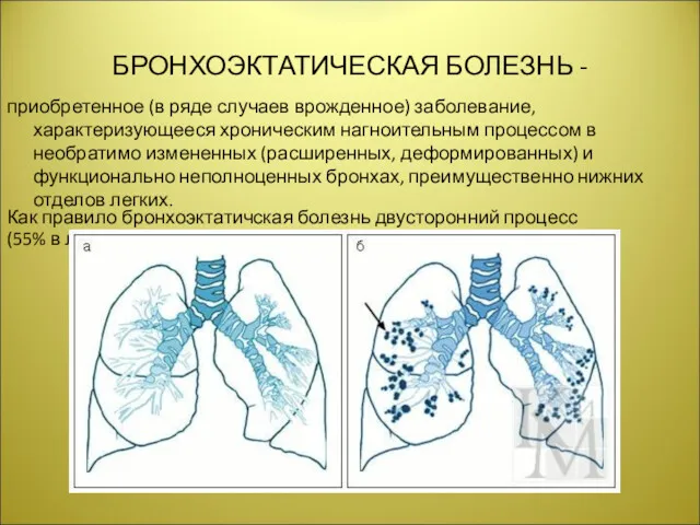 БРОНХОЭКТАТИЧЕСКАЯ БОЛЕЗНЬ - приобретенное (в ряде случаев врожденное) заболевание, характеризующееся