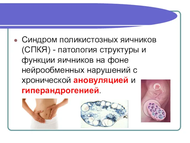 Синдром поликистозных яичников (СПКЯ) - патология структуры и функции яичников