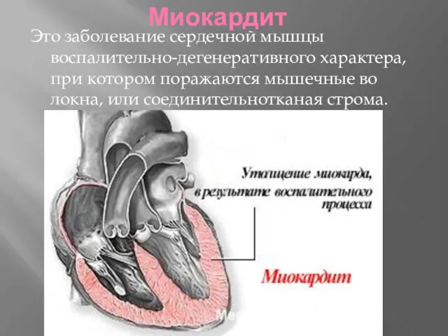 Миокардит Это заболевание сердечной мышцы воспалительно-дегенеративного характера, при котором поражаются мышечные во­локна, или соединительнотканая строма.