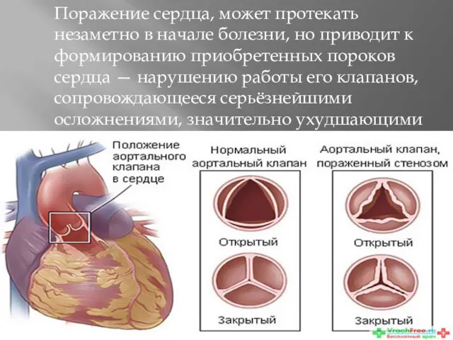 Поражение сердца, может протекать незаметно в начале болезни, но приводит