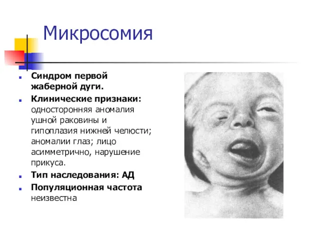 Микросомия Синдром первой жаберной дуги. Клинические признаки: односторонняя аномалия ушной