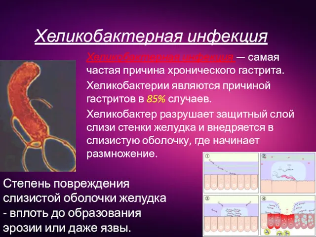 Хеликобактерная инфекция Хеликобактерная инфекция — самая частая причина хронического гастрита.