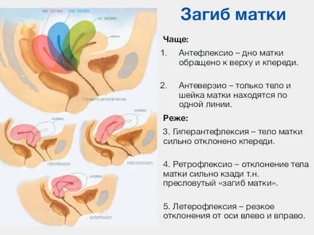 Загиб матки Чаще: Антефлексио – дно матки обращено к верху