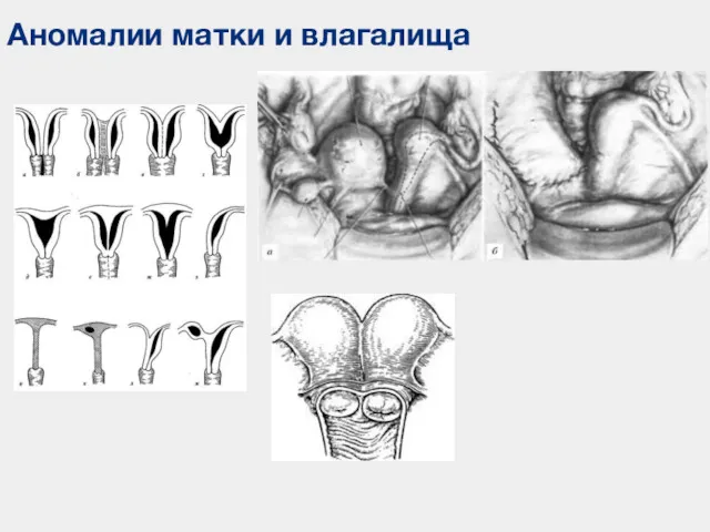 Аномалии матки и влагалища