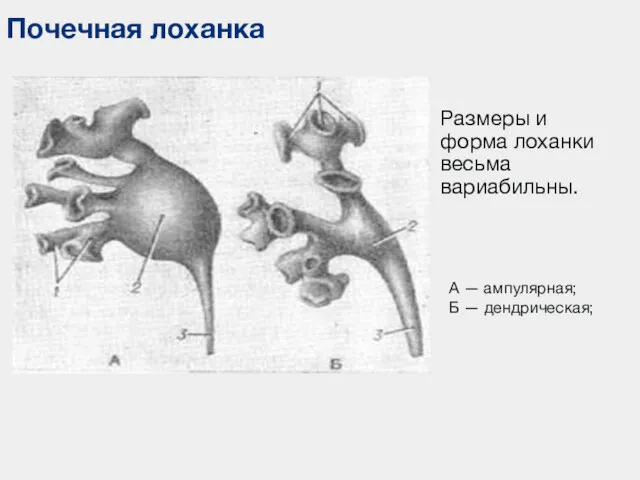 Размеры и форма лоханки весьма вариабильны. Почечная лоханка А — ампулярная; Б — дендрическая;