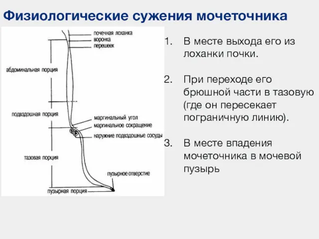 Физиологические сужения мочеточника В месте выхода его из лоханки почки.