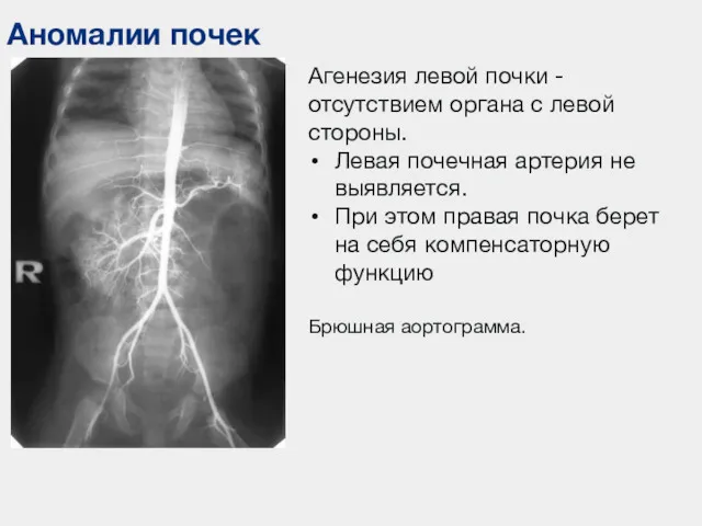 Аномалии почек Агенезия левой почки -отсутствием органа с левой стороны.