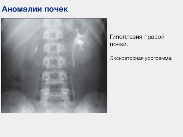 Аномалии почек Гипоплазия правой почки. Экскреторная урограмма.