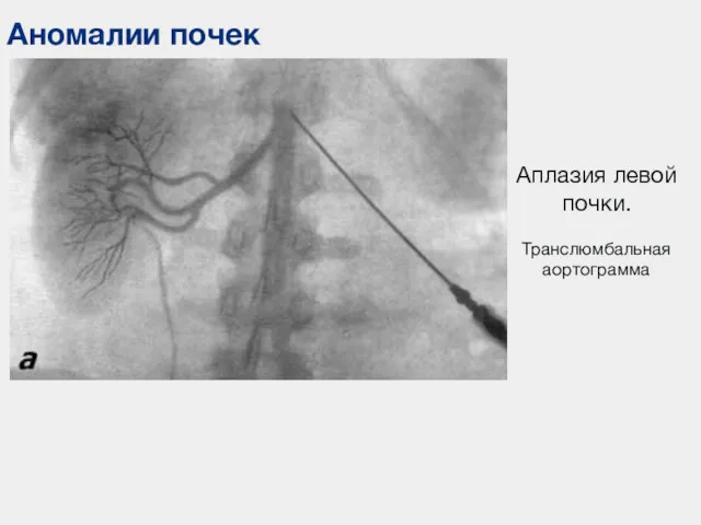 Аномалии почек Аплазия левой почки. Транслюмбальная аортограмма