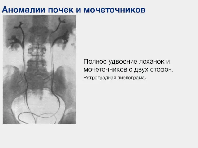 Аномалии почек и мочеточников Полное удвоение лоханок и мочеточников с двух сторон. Ретроградная пиелограма.