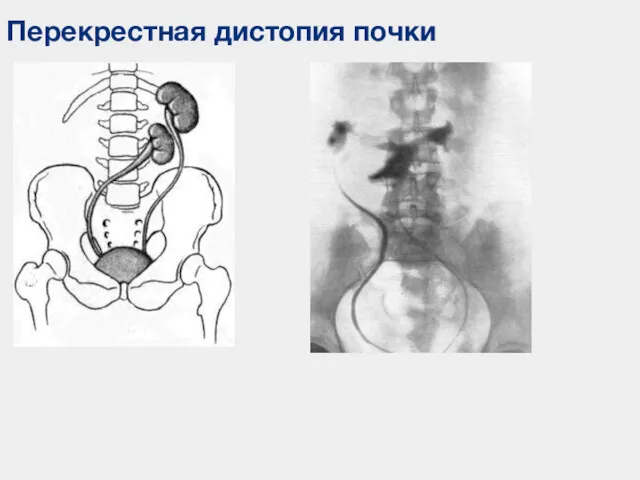 Перекрестная дистопия почки