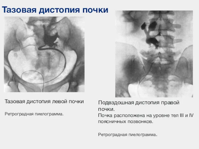 Тазовая дистопия почки Тазовая дистопия левой почки Ретроградная пиелограмма. Подвздошная