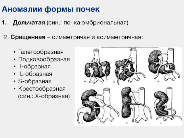 Аномалии формы почек Дольчатая (син.: почка эмбриональная) 2. Сращенная –