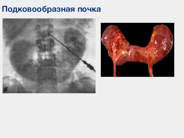 Подковообразная почка