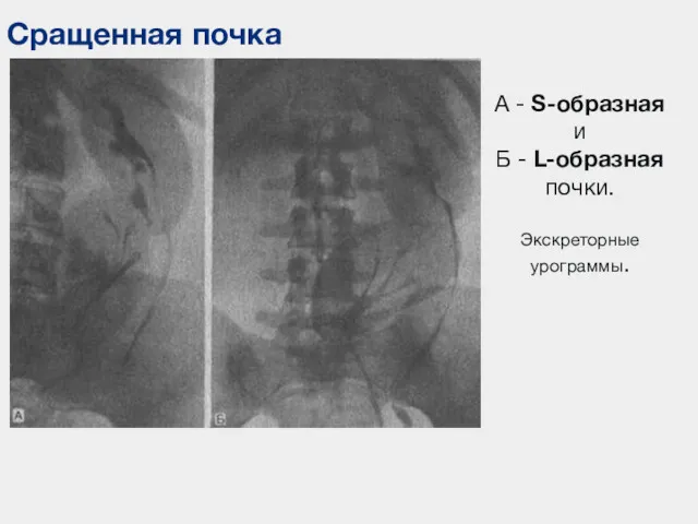 Сращенная почка А - S-образная и Б - L-образная почки. Экскреторные урограммы.