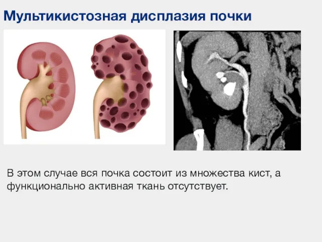 Мультикистозная дисплазия почки В этом случае вся почка состоит из