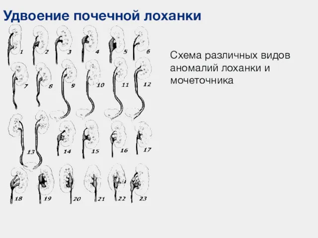 Удвоение почечной лоханки Схема различных видов аномалий лоханки и мочеточника