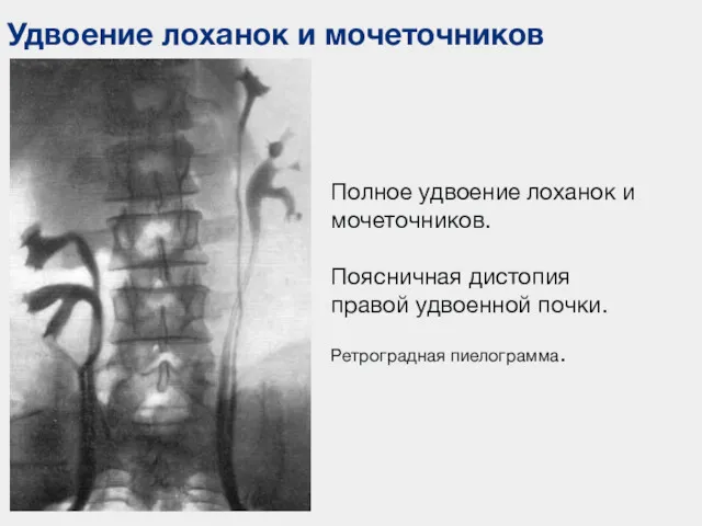 Удвоение лоханок и мочеточников Полное удвоение лоханок и мочеточников. Поясничная дистопия правой удвоенной почки. Ретроградная пиелограмма.