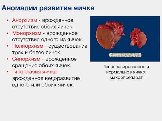 Аномалии развития яичка Гипоплазированное и нормальное яичко, макропрепарат Анорхизм -