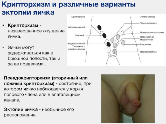 Крипторхизм и различные варианты эктопии яичка Крипторхизм - незавершенное опущение