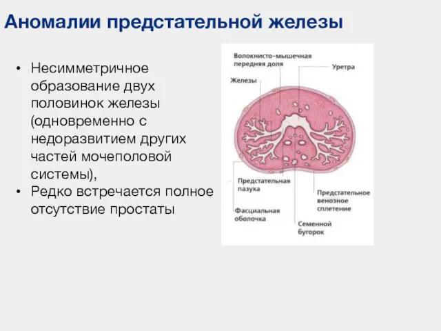 Аномалии предстательной железы Несимметричное образование двух половинок железы (одновременно с