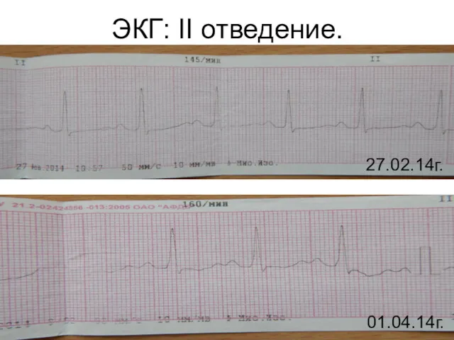 ЭКГ: II отведение. 27.02.14г. 01.04.14г.