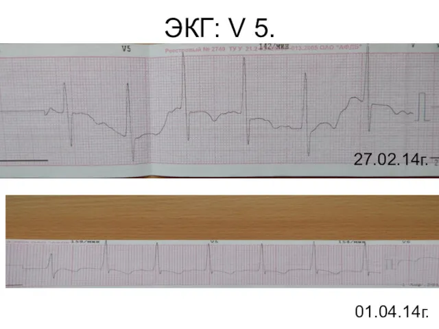 ЭКГ: V 5. 27.02.14г. 01.04.14г.