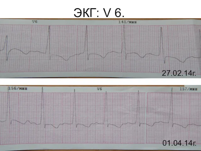 ЭКГ: V 6. 27.02.14г. 01.04.14г.