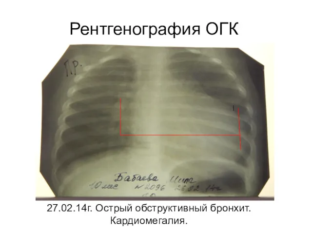 27.02.14г. Острый обструктивный бронхит. Кардиомегалия. Рентгенография ОГК