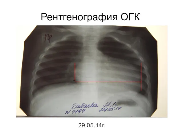 Рентгенография ОГК 29.05.14г.