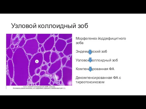 Узловой коллоидный зоб Морфогенез йоддефицитного зоба Эндемический зоб Узловой коллоидный