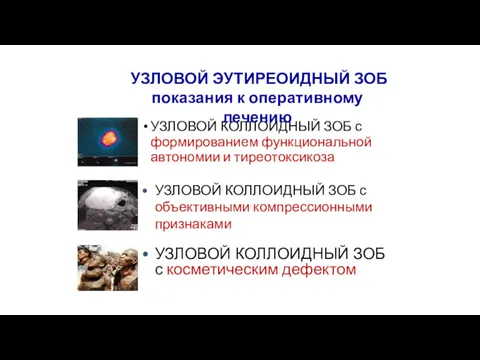 УЗЛОВОЙ КОЛЛОИДНЫЙ ЗОБ с формированием функциональной автономии и тиреотоксикоза УЗЛОВОЙ