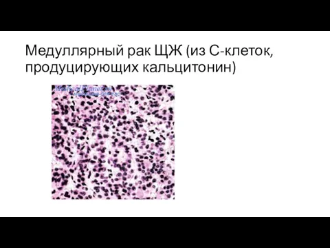 Медуллярный рак ЩЖ (из С-клеток, продуцирующих кальцитонин)