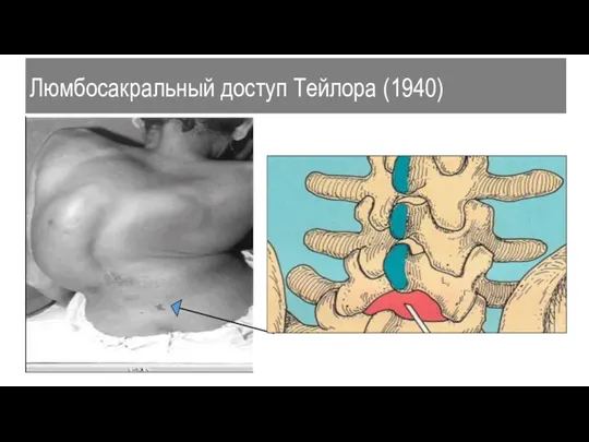 Люмбосакральный доступ Тейлора (1940)