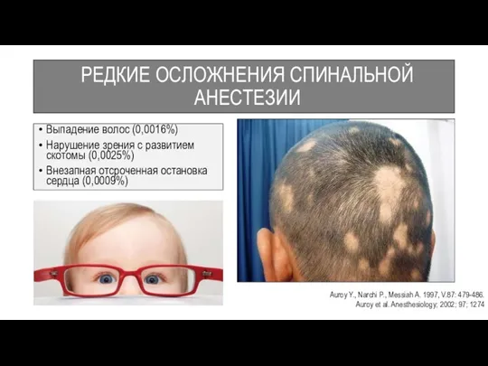 РЕДКИЕ ОСЛОЖНЕНИЯ СПИНАЛЬНОЙ АНЕСТЕЗИИ Выпадение волос (0,0016%) Нарушение зрения с развитием скотомы (0,0025%)