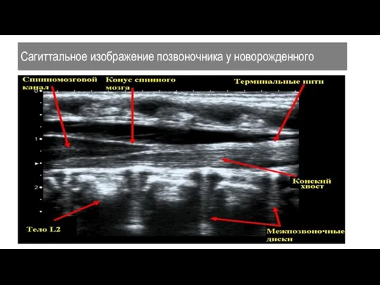 Сагиттальное изображение позвоночника у новорожденного