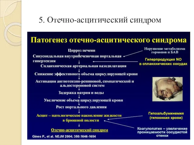 5. Отечно-асцитический синдром