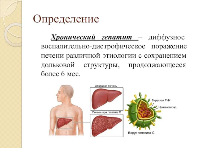 Определение Хронический гепатит – диффузное воспалительно-дистрофическое поражение печени различной этиологии